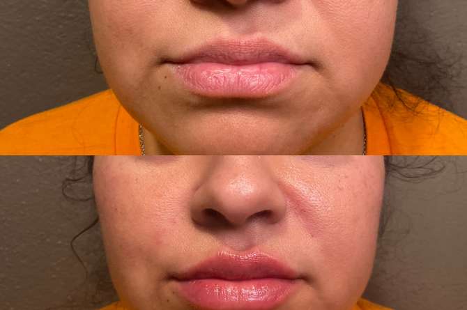Before and after image of Juvederm results on lips.