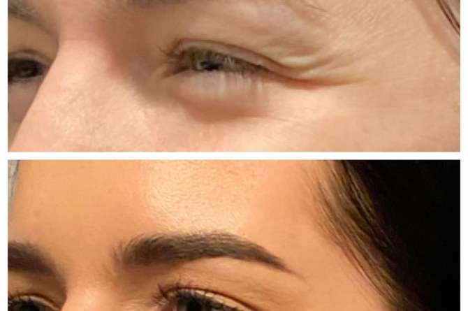 Before and after image of Botox results on crows feet.
