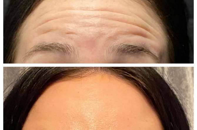 Before and after image of Botox results on forehead lines.