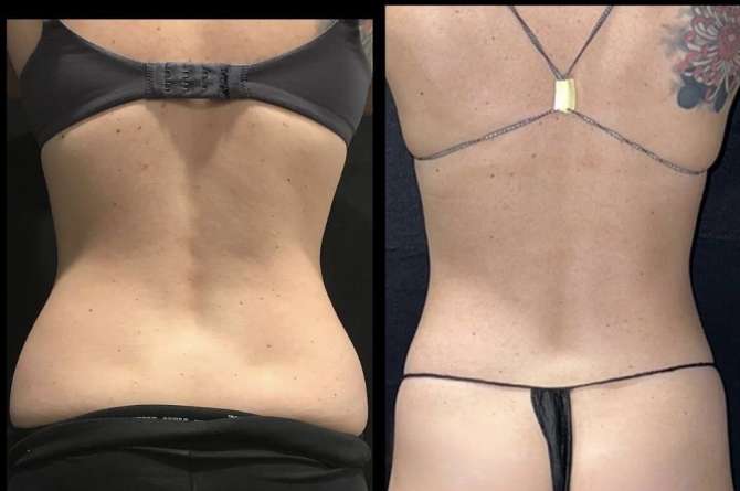 Before and after images of coolsculpting treatment where the flanks become more defined.