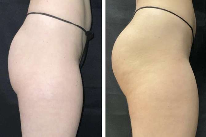 A before and after image of glutes after the emsculpt treatment, with the after image showing more round muscles.