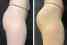 A before and after image of glutes after the emsculpt treatment, with the after image showing more round muscles.