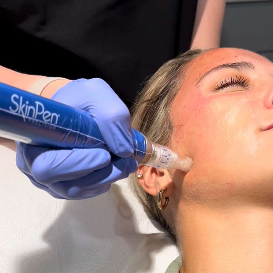 Woman receiving microneedling treatment on her face.