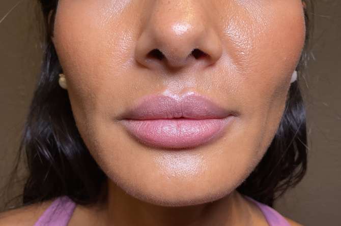 Healed Juvederm results on lips.