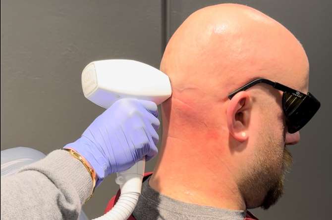 Inmode Diolaze Laser Hair Removal to man patient’s scalp and neck