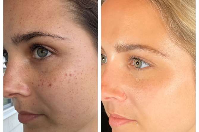 Before and after photo of Lumecca IPL Laser Results on face.