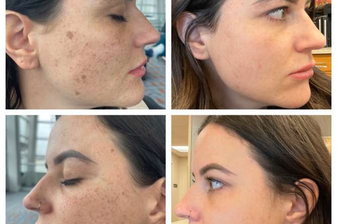 Before and after photo of Lumecca IPL Laser Results on face.