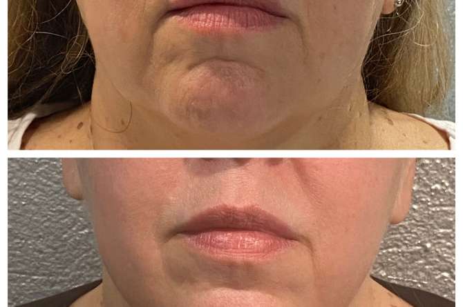 Before and after image of microneedling results on lower face.