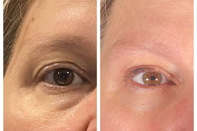 Before and after image of microneedling results on eyes.