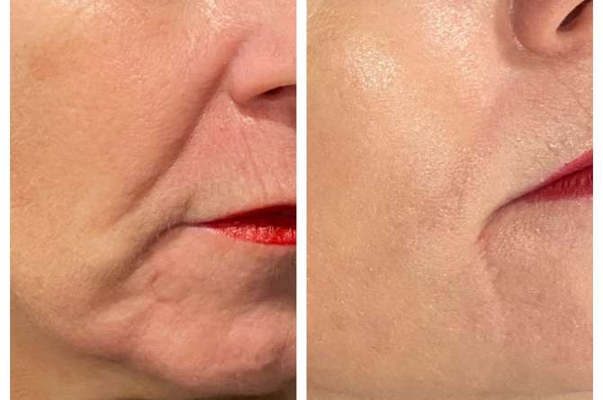 Before and after image of microneedling results on face.